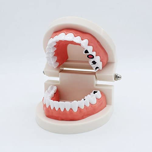 Airgoesin Dental Standard Teeth Study Teaching Model Kids Patient Education Caries Treatment Decayed Tooth Model