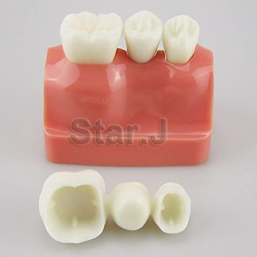 Dental Implant Study Analysis Crown Bridge Demonstration Teeth Model