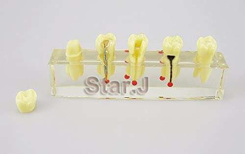 Dental Dentist Endo Endodontic Demonstration Root Treatment Model