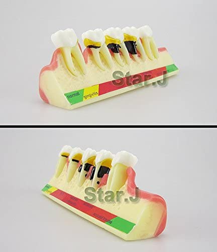 Dental Periodontal Disease assort Tooth Teeth Typodont Study Teaching Model New