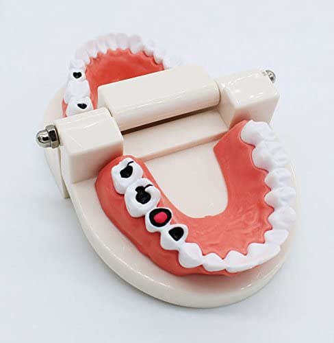 Airgoesin Dental Standard Teeth Study Teaching Model Kids Patient Education Caries Treatment Decayed Tooth Model