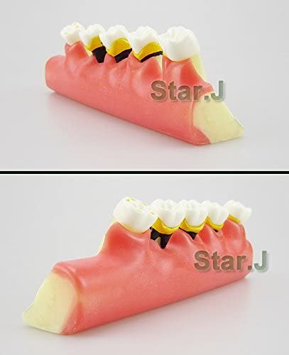 Dental Periodontal Disease assort Tooth Teeth Typodont Study Teaching Model New