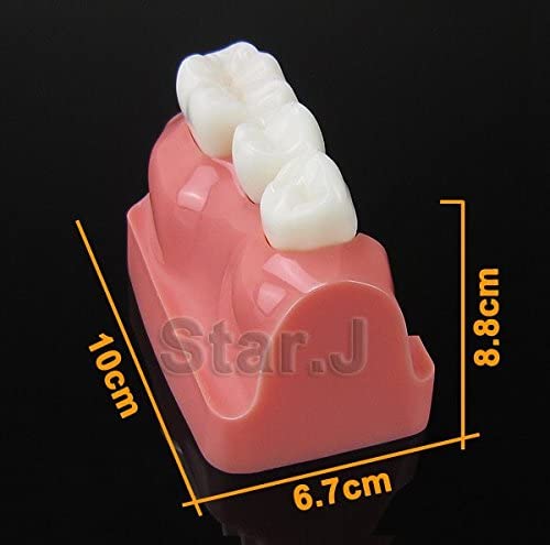 Dental Implant Study Analysis Crown Bridge Demonstration Teeth Model