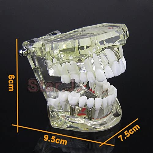 Dental Implant Study Analysis Demonstration Teeth Model with Restoration