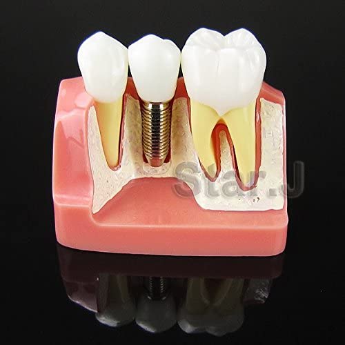Dental Implant Study Analysis Crown Bridge Demonstration Teeth Model