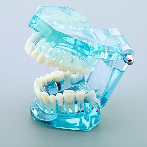 Airgoesin Dental Implant Study Analysis Demonstration Teeth Model with Restoration Blue