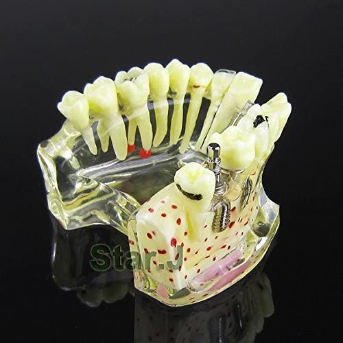 Dental Study Teaching Model Teeth Implant Model Osteoporosis and Caries - New
