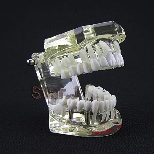 Dental Implant Study Analysis Demonstration Teeth Model with Restoration