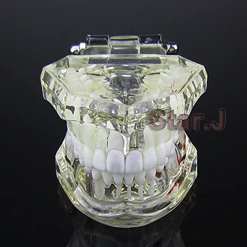 Dental Implant Study Analysis Demonstration Teeth Model with Restoration