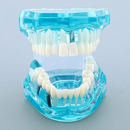 Airgoesin Dental Implant Study Analysis Demonstration Teeth Model with Restoration Blue