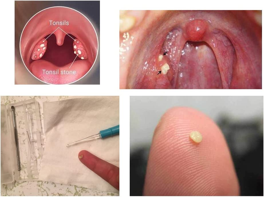 Airgoesin 2 Sets Flashlight Tonsil Stone Removing Tool, with Box + 1 Stainless Steel Tonsillolith Pick + 1 Irrigation Syringe