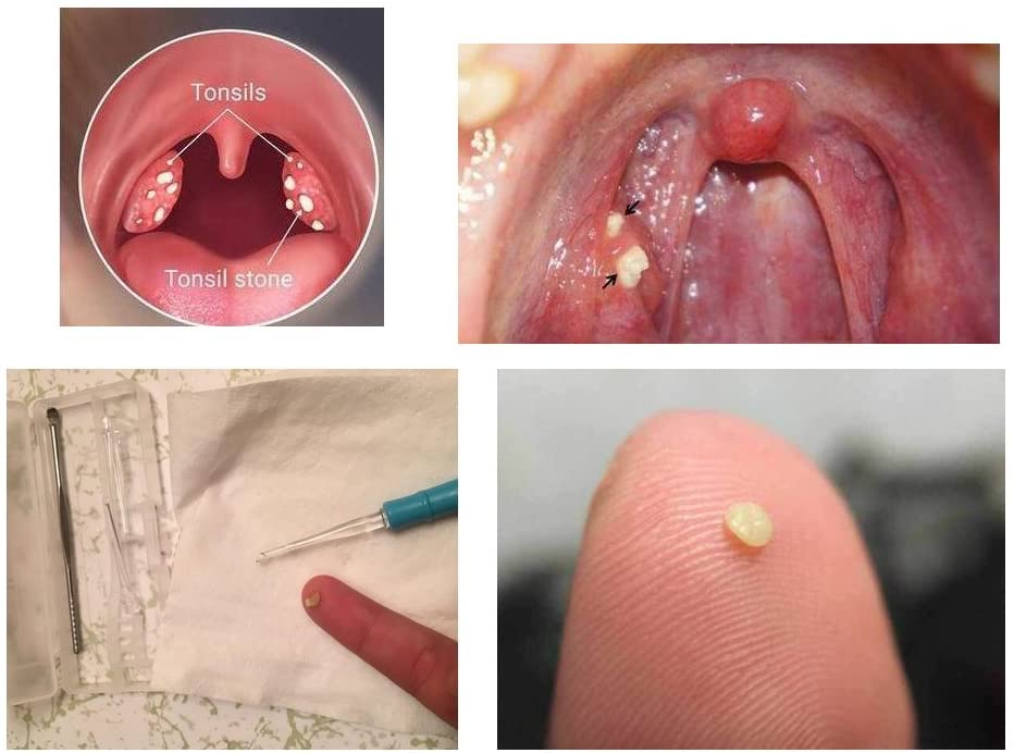 Airgoesin Tonsil Stone Removing Tool, 5 Adapters Tips, Tonsillolith Pick + Case + Gift