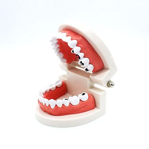Airgoesin Dental Standard Teeth Study Teaching Model Kids Patient Education Caries Treatment Decayed Tooth Model