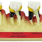 Dental Periodontal Disease assort Tooth Teeth Typodont Study Teaching Model New
