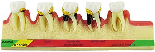 Dental Periodontal Disease assort Tooth Teeth Typodont Study Teaching Model New