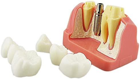 Dental Implant Study Analysis Crown Bridge Demonstration Teeth Model