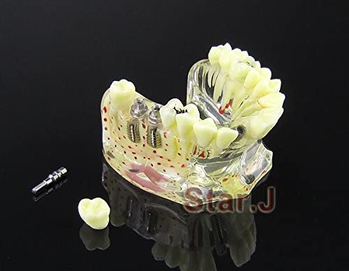 Dental Study Teaching Model Teeth Implant Model Osteoporosis and Caries - New