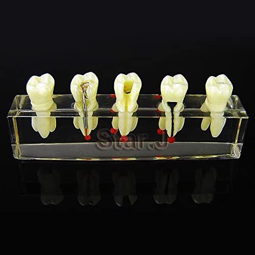 Dental Dentist Endo Endodontic Demonstration Root Treatment Model