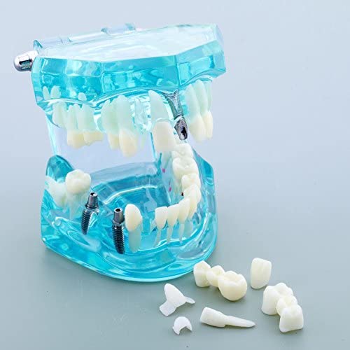 Airgoesin Dental Implant Study Analysis Demonstration Teeth Model with Restoration Blue