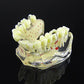 Dental Study Teaching Model Teeth Implant Model Osteoporosis and Caries - New