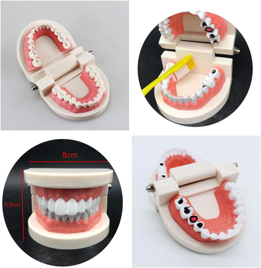 Airgoesin 2pcs Tooth Brushing Model Standard Typodont Demonstration Teeth Disease Decayed Teeth Model for Kids and Students Study Teaching Dental Clinic Oral Care